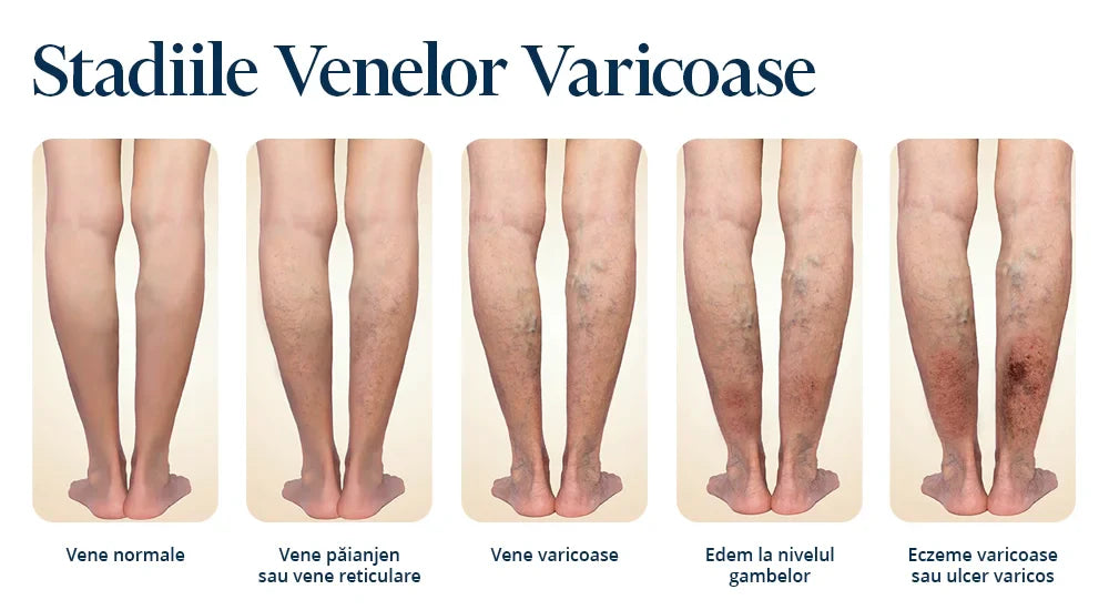 Leacuri Bătrânești pentru Varice